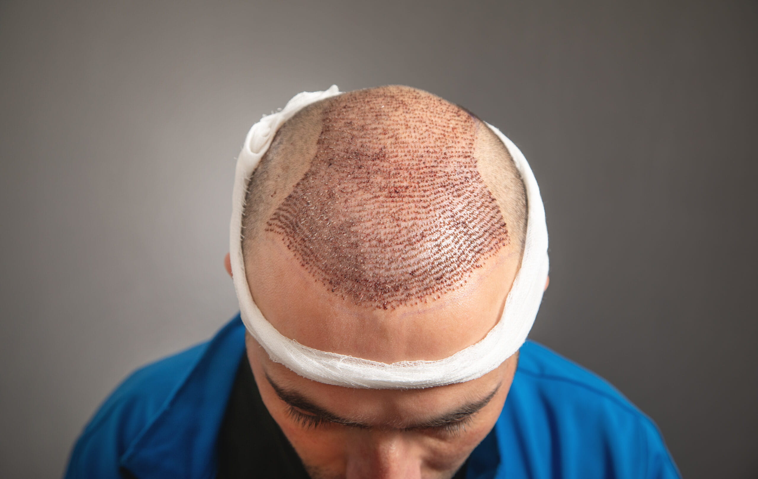 Hair Restoration